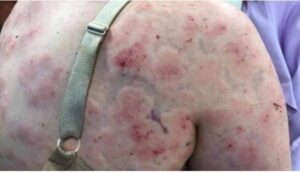 Mulher se fere ao usar o próprio corpo como escudo para proteger o bebê de chuva de granizo