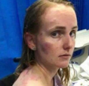 Mulher se fere ao usar o próprio corpo como escudo para proteger o bebê de chuva de granizo