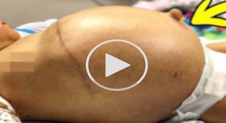 Médicos GRITARAM ao saber o que havia dentro da barriga desse recém nascido ‘SURPREENDENTE’; veja o vídeo