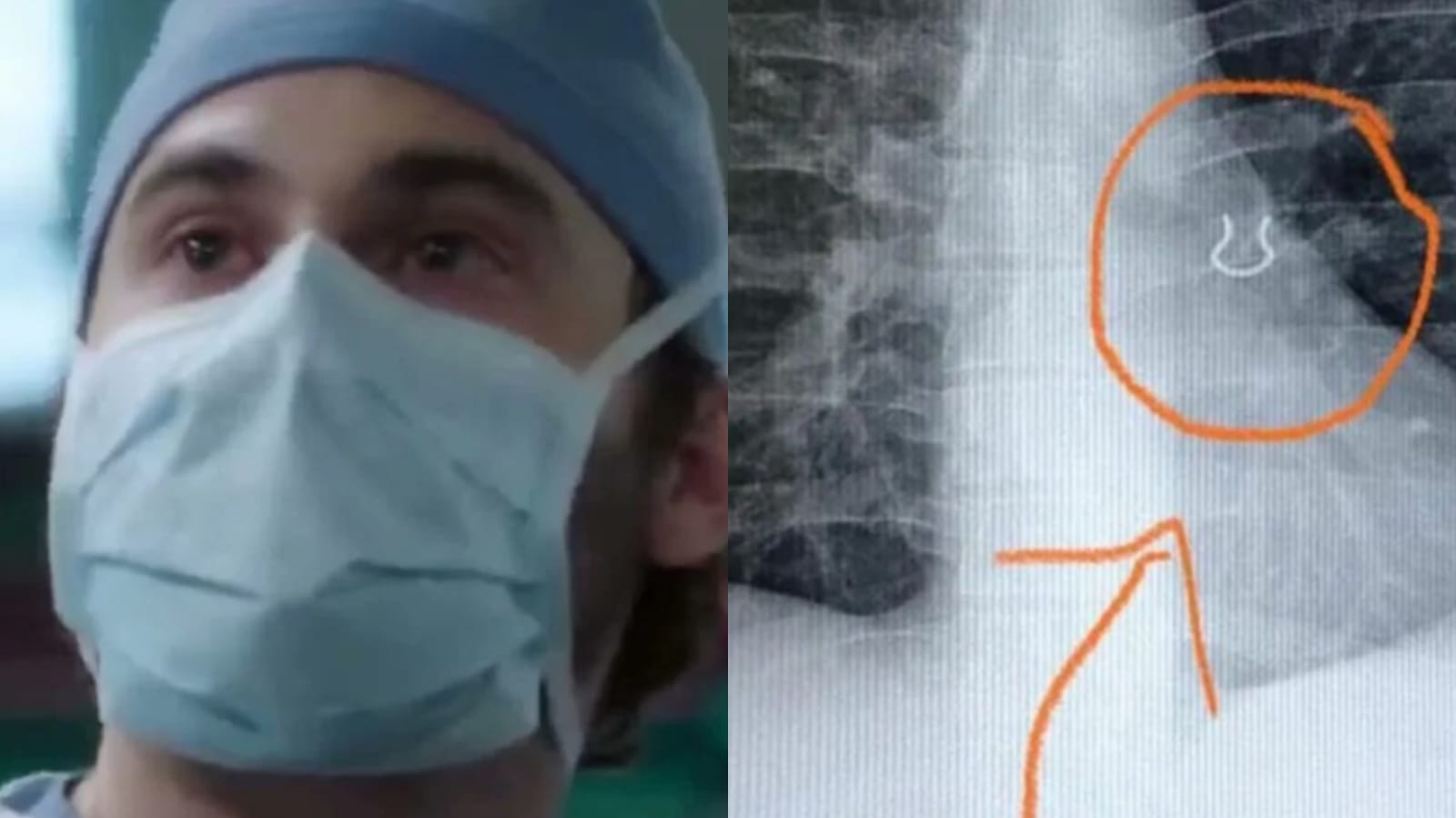 Médicos ficam chocados com objeto alojado no pulmão de paciente por cinco anos!