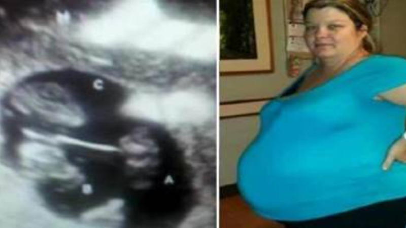 Mãe engravida pela quinta vez, mas quando os médicos veem ultrassom, a sala inteira fica incrédula