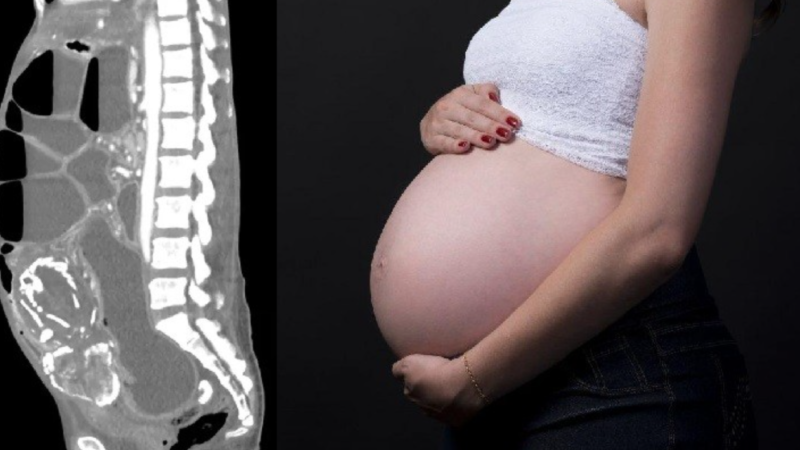 Maltratada por médicos, mulher carrega feto calcificado por 9 anos no intestino e acaba falecendo depois que o feto explo… Ver mais