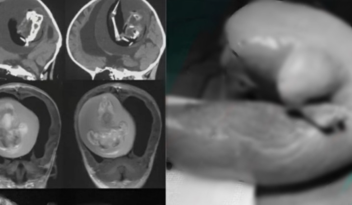 Os médicos retiraram o feto da cabeça da menina. Foto: internet.