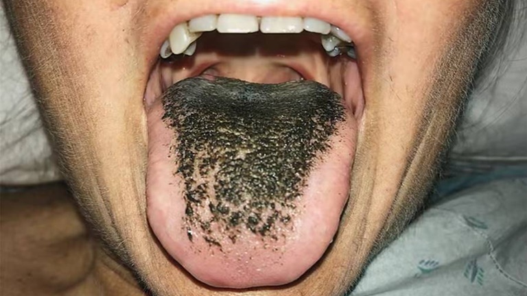 Mulher fica com língua peluda e preta após tomar um Remédio conhecido como…saiba mais