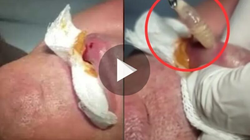 Olha o tamanho dessa larva que foi removido da boca – Veja o video