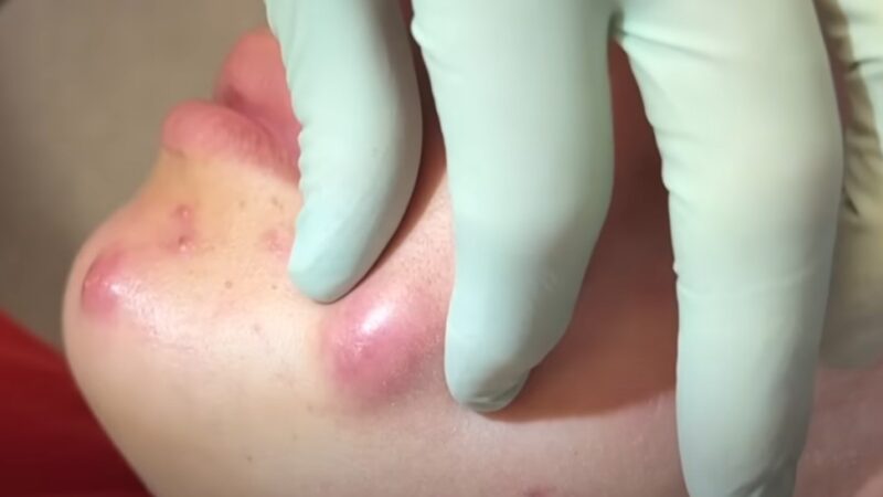 Meu Deus! Veja o que tinha nessa espinha; É inacreditável o que saiu dela – Confira o vídeo!