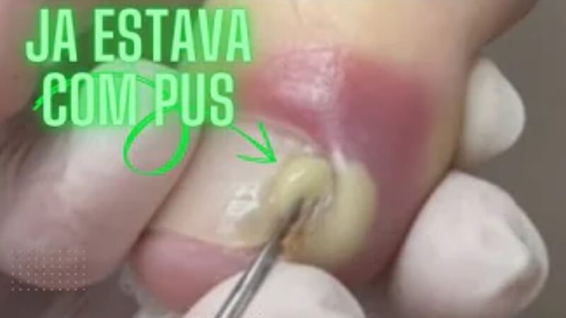 Meu Deus! Veja o que tinha nessa unha; É inacreditável o que saiu dela – Confira o vídeo!
