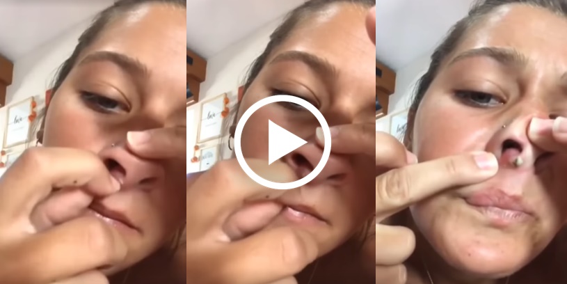 Imagem de uma mulher removendo uma enorme acne.