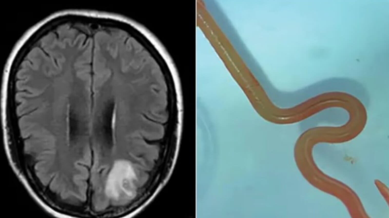 Uma mulher australiana, residente em Nova Gales do Sul, que abrigava um verme parasita surpreendente em seu cérebro. FOTO: internet.