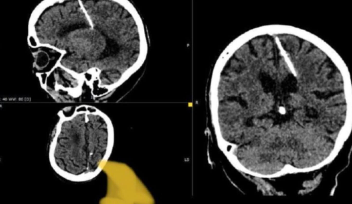 Uma descoberta médica chocante veio à tona, envolvendo uma mulher de 80 anos que vive com uma agulha de 3 centímetros alojada em seu cérebro. FOTO: internet