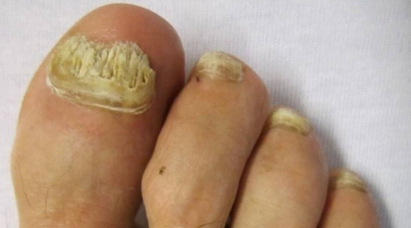 A micose de unha, também conhecida como “unheiro” ou “onicomicose”, é um problema comum causado por fungos que afeta tanto as unhas dos pés. FOTO: internet