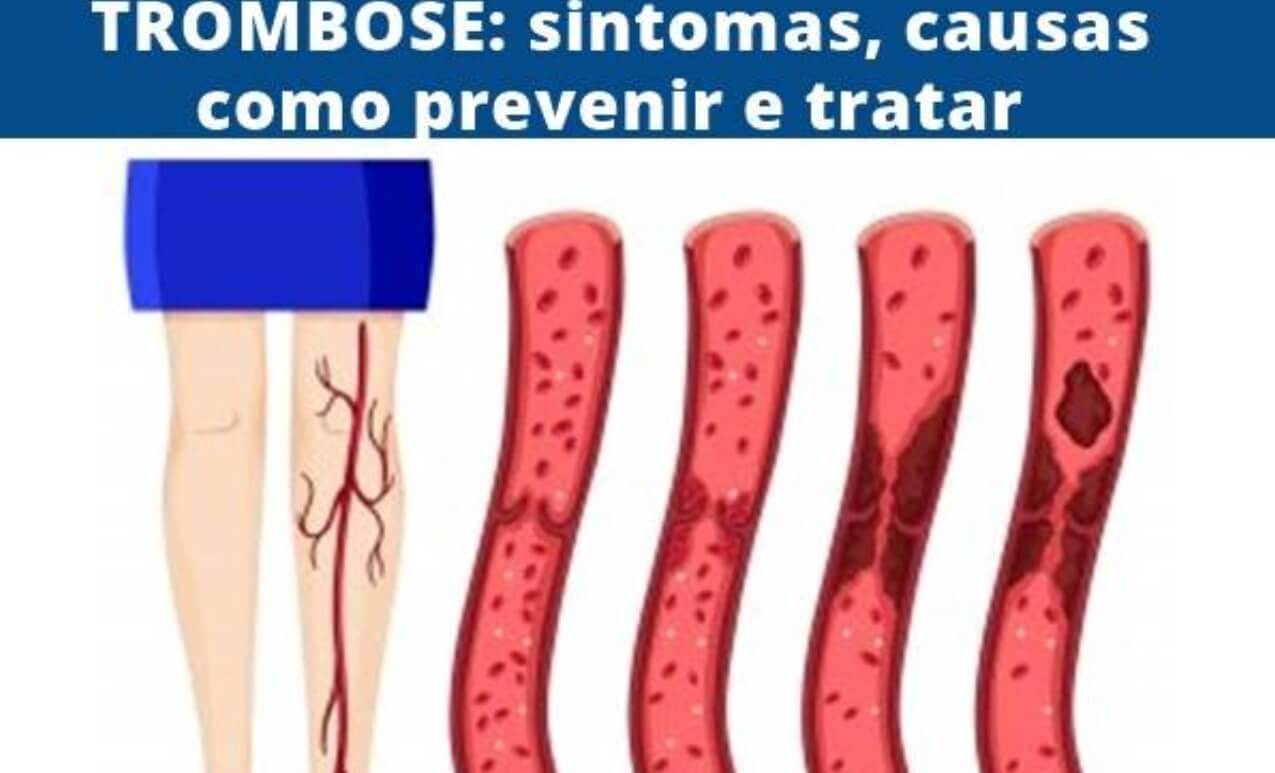 A trombose, condição médica grave caracterizada pela formação de coágulos sanguíneos, conhecidos como trombos, dentro do vaso sanguíneo. FOTO: internet
