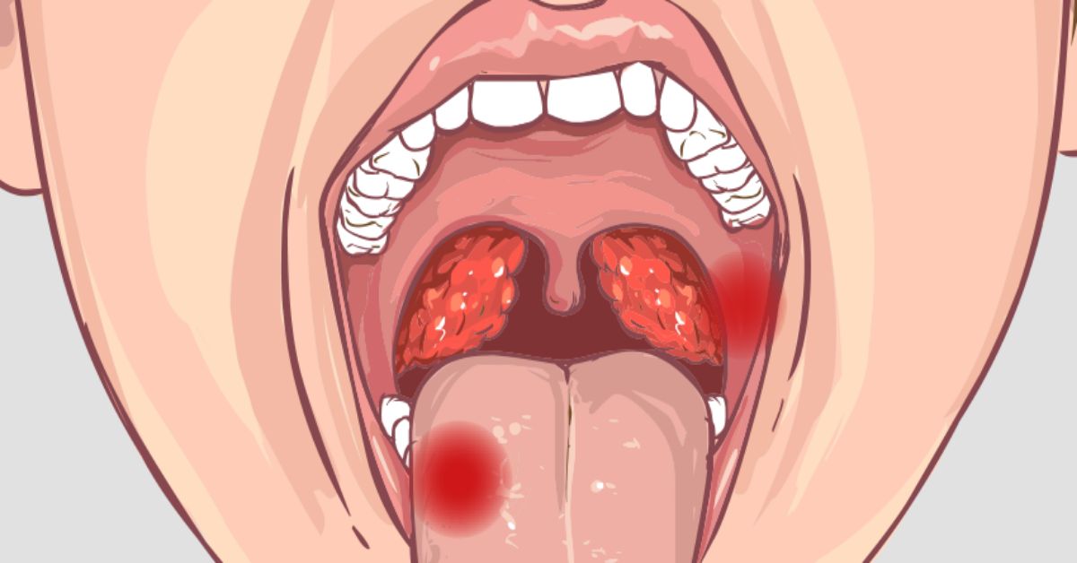 O câncer de boca é um tipo de câncer que pode afetar qualquer parte da boca